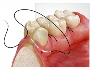 Снятие швов – Хирургическая стоматология