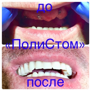 Пример имплантации зубов