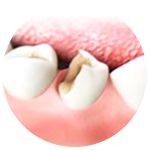 Удаление стенки зуба