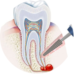 Зубоохраняющие операции